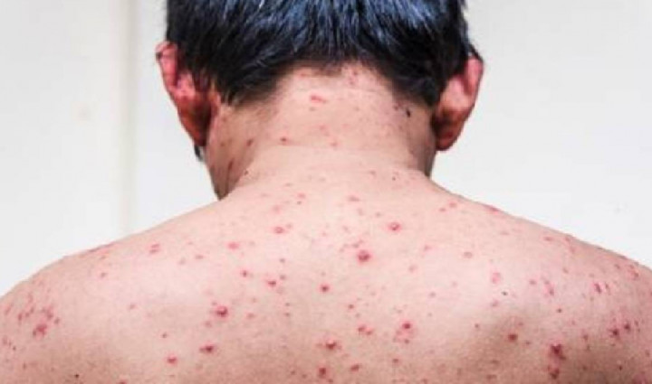 हुम्लाका ५७ विद्यार्थीमा देखियो ठेउला