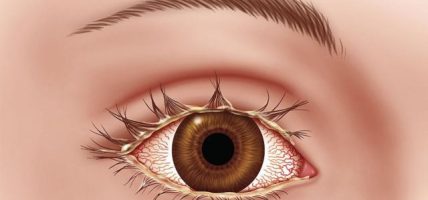 जुम्लामा एक सय बाइस जनाको मोतिविन्दुको निःशुल्क शल्यक्रिया