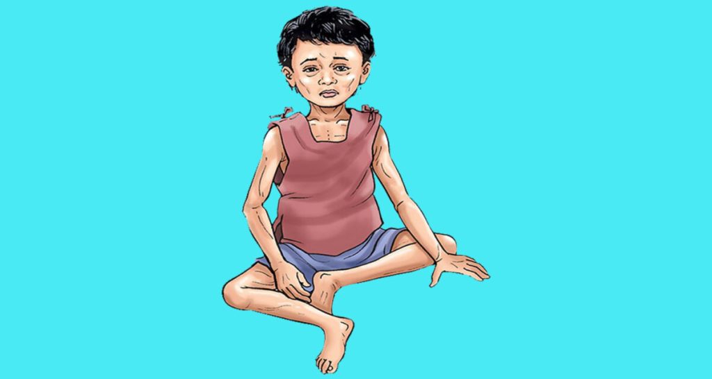 पोषण लेखाजोखा : तीन सय ४७ बालबालिका कुपोषित