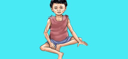 पोषण लेखाजोखा : तीन सय ४७ बालबालिका कुपोषित