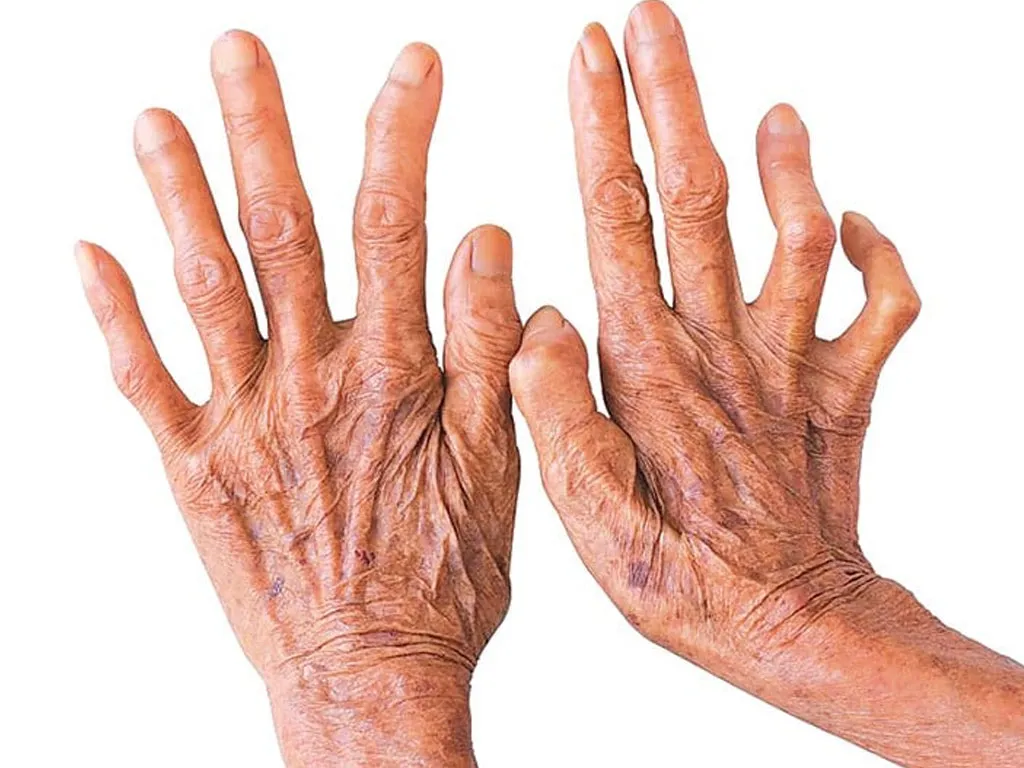 चितवनमा १८ जनामा कुष्ठरोगको सङ्क्रमण