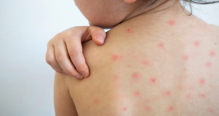 मलंगवामा सकियो दादुरा विरुद्धको खोप अभियान