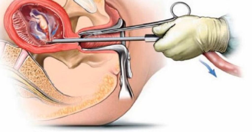 झापामा तीन वर्षमा छ सय लिए सुरक्षित गर्भपतन सेवा