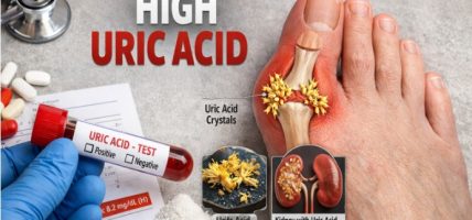 युरिक एसिडका बिरामीले के खानु हुन्छ, के खानु हुदैँन ? जान्नुहोस्