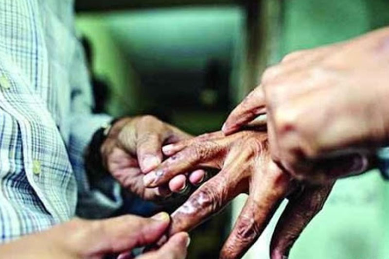 बाँकेमा १९३ कुष्ठरोगी