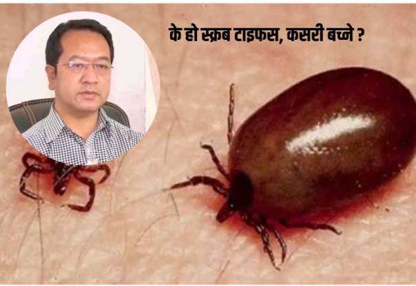स्क्रब टाइफस : संक्रमणबाट जोगिन शरीर राम्ररी ढाक्ने कपडा लगाउन चिकित्सकको सुझाव स्क्रब टाइफस : संक्रमणबाट जोगिन शरीर राम्ररी ढाक्ने कपडा लगाउन चिकित्सकको सुझाव