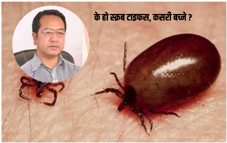 स्क्रब टाइफस : संक्रमणबाट जोगिन शरीर राम्ररी ढाक्ने कपडा लगाउन चिकित्सकको सुझाव